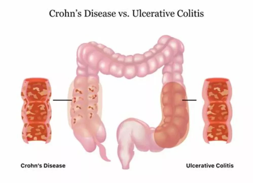 The Connection Between Crohn's Disease and Heart Conditions: Causes and Treatments
